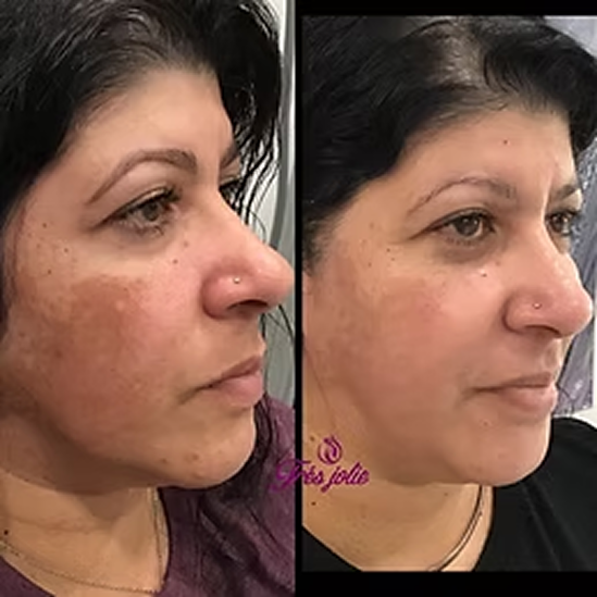 IPL Photofacial Treatments