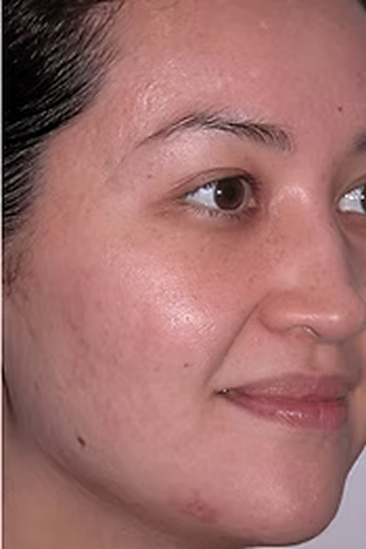 Microdermabrasion