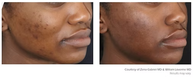 Microneedling RF