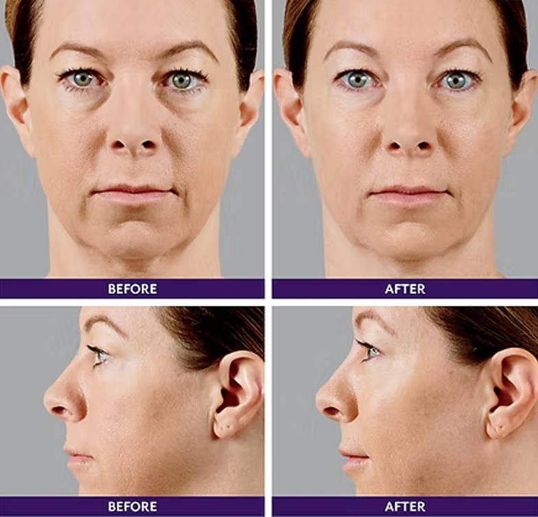 Restylane and Restylane Silk